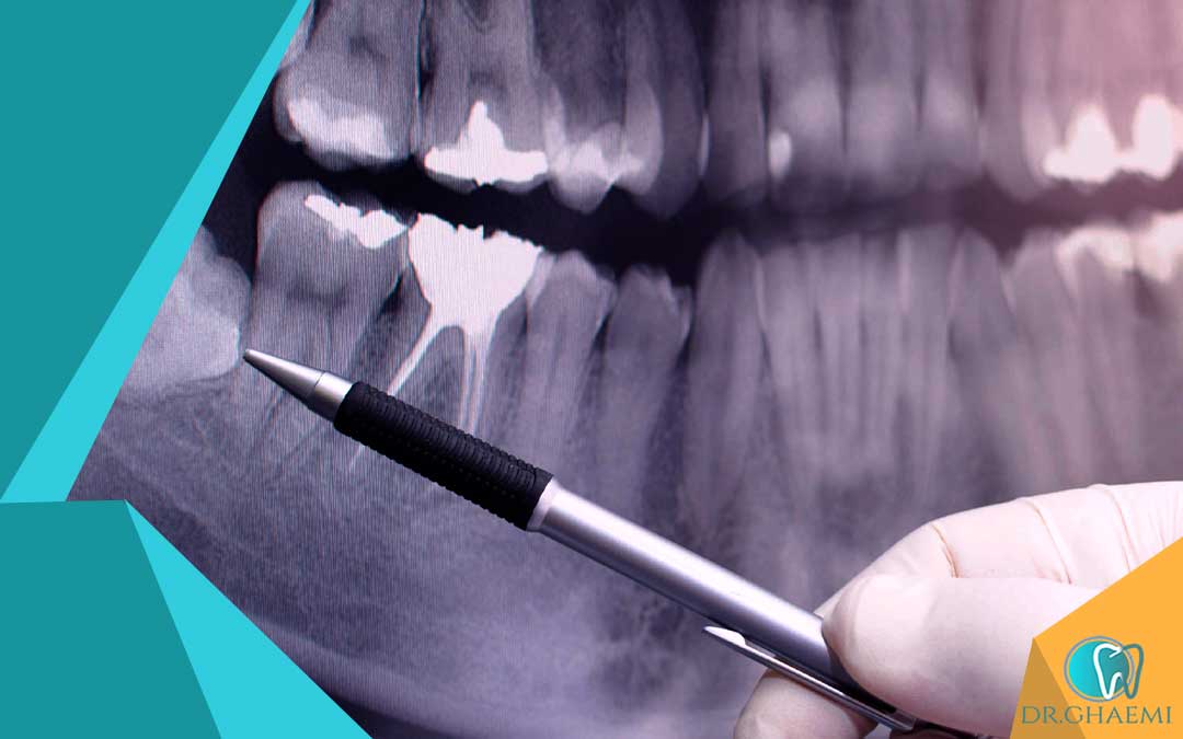 دلایل جراحی دندان عقل