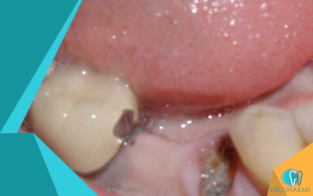 روند بهبودی بعد از کشیدن دندان