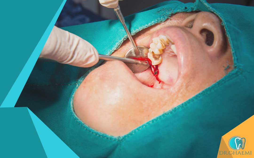 عکس جراحی دندان عقل