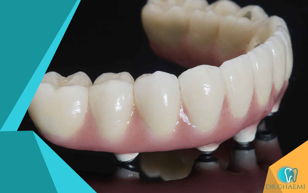 ساخت دندان مصنوعی چند روز طول می کشد چند بار باید مراجع کنیم؟