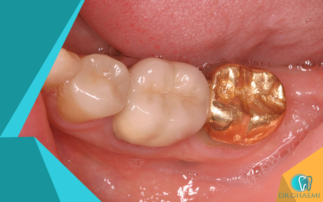 چرا ترمیم دندان قبل از سفید کردن دندان ضروری است؟