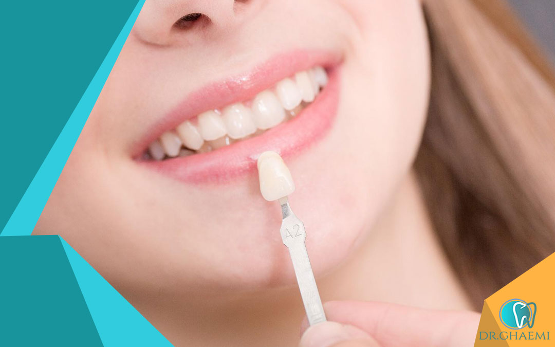 مراحل درمان لمینت دندان سرامیکی چیست؟