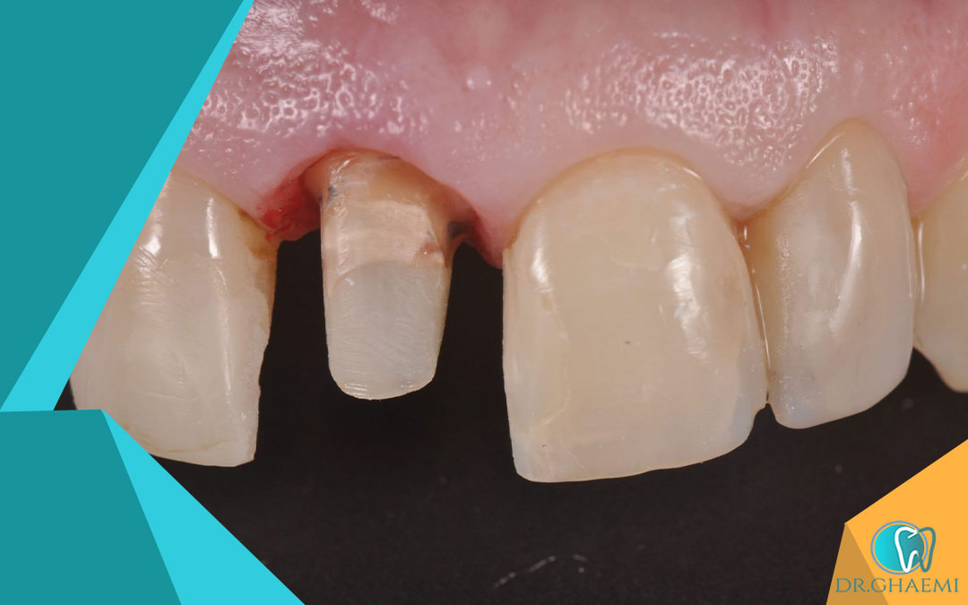 آیا می توان دندان هایی را که بافت زیادی از دست داده اند ترمیم کرد؟
