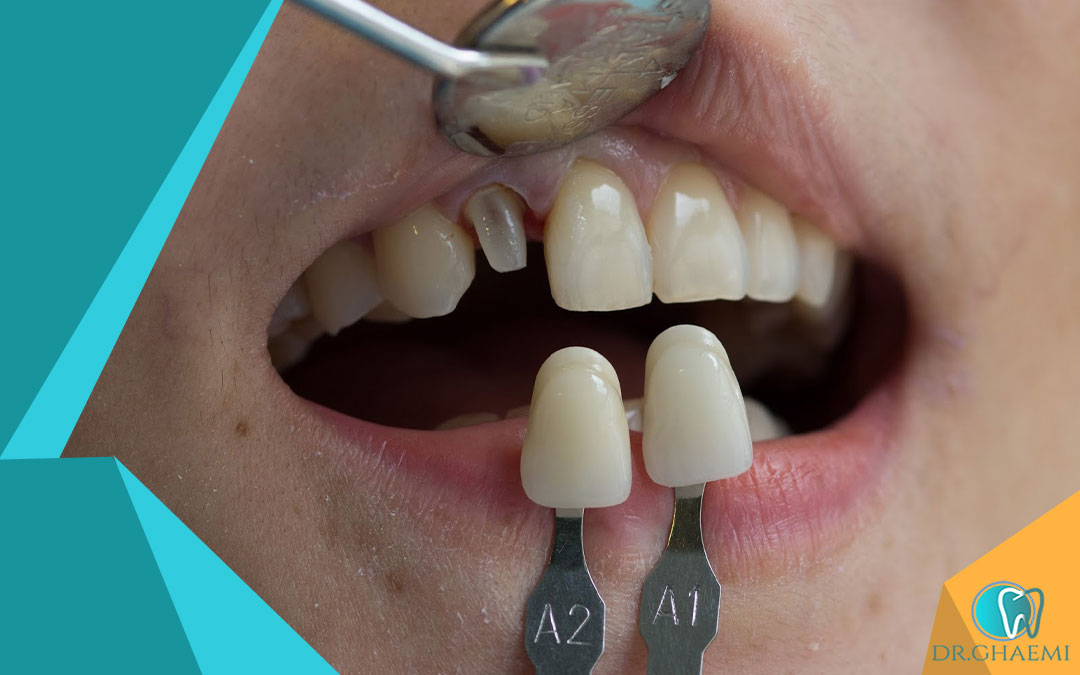 ماندگاری روکش دندان چقدر است؟