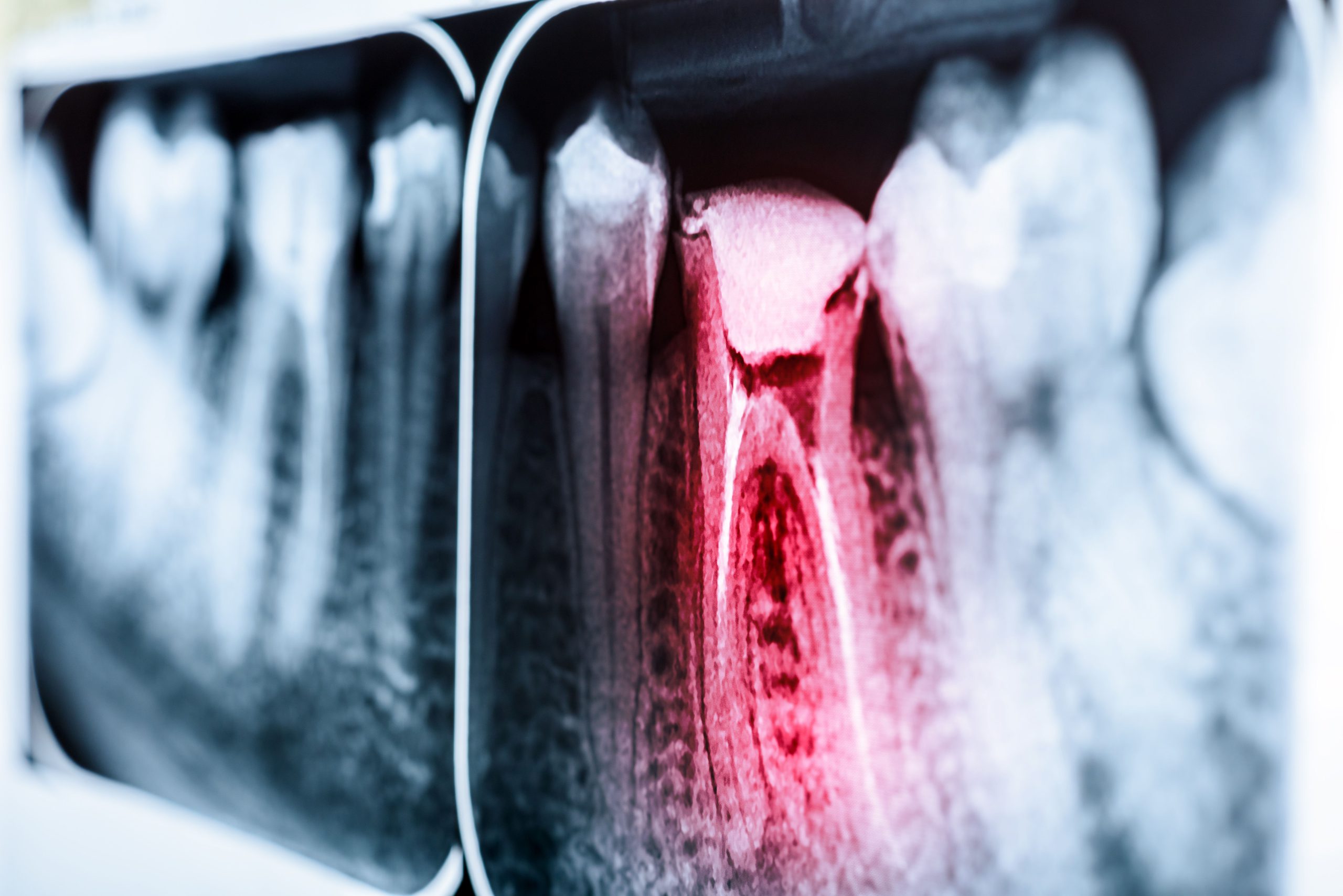 آنتی بیوتیک برای عفونت دندان scaled