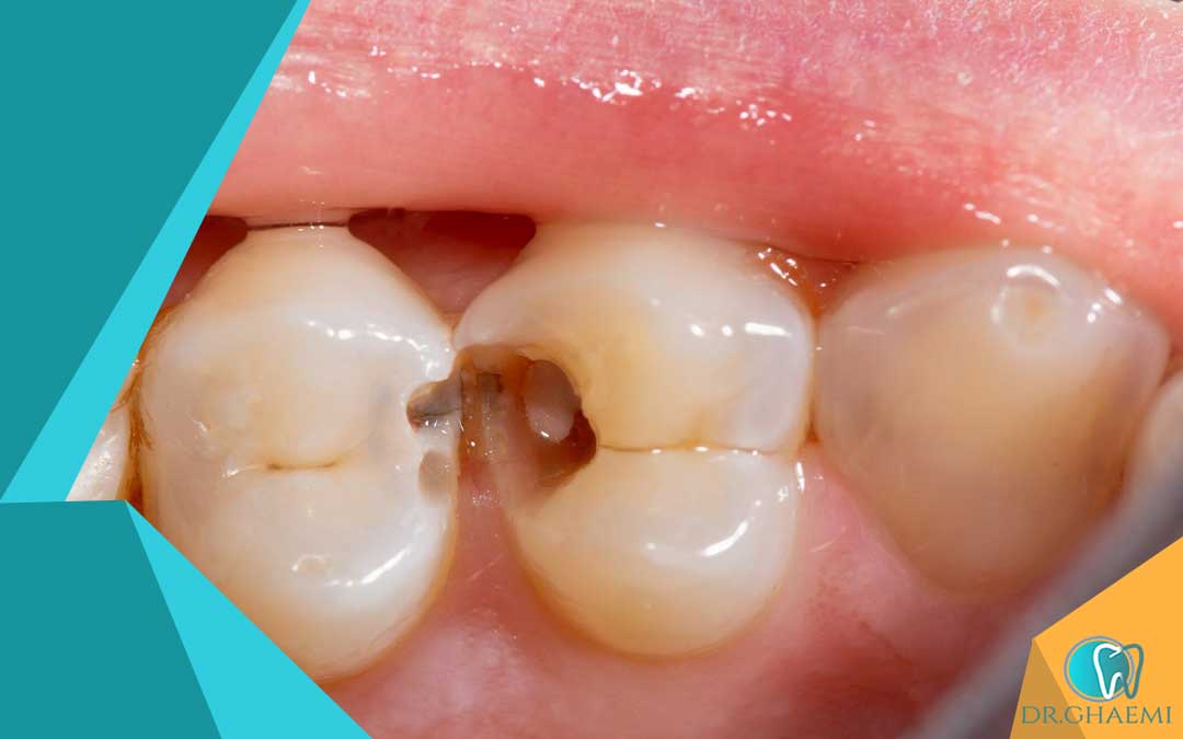 دندان درد و پوسیدگی دندان