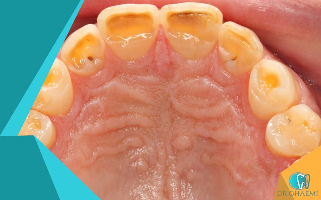 اثرات دندان قروچه روی زیباییی دندان ها