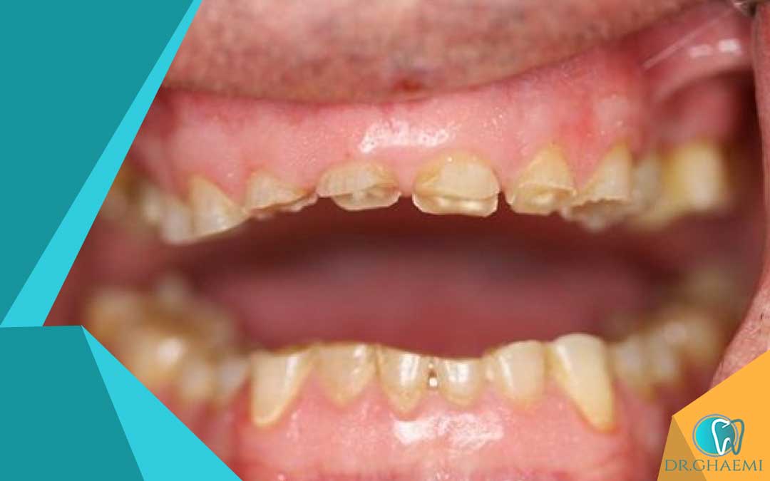 دندون‌ قروچه و فرسایش شدید دندان ها 