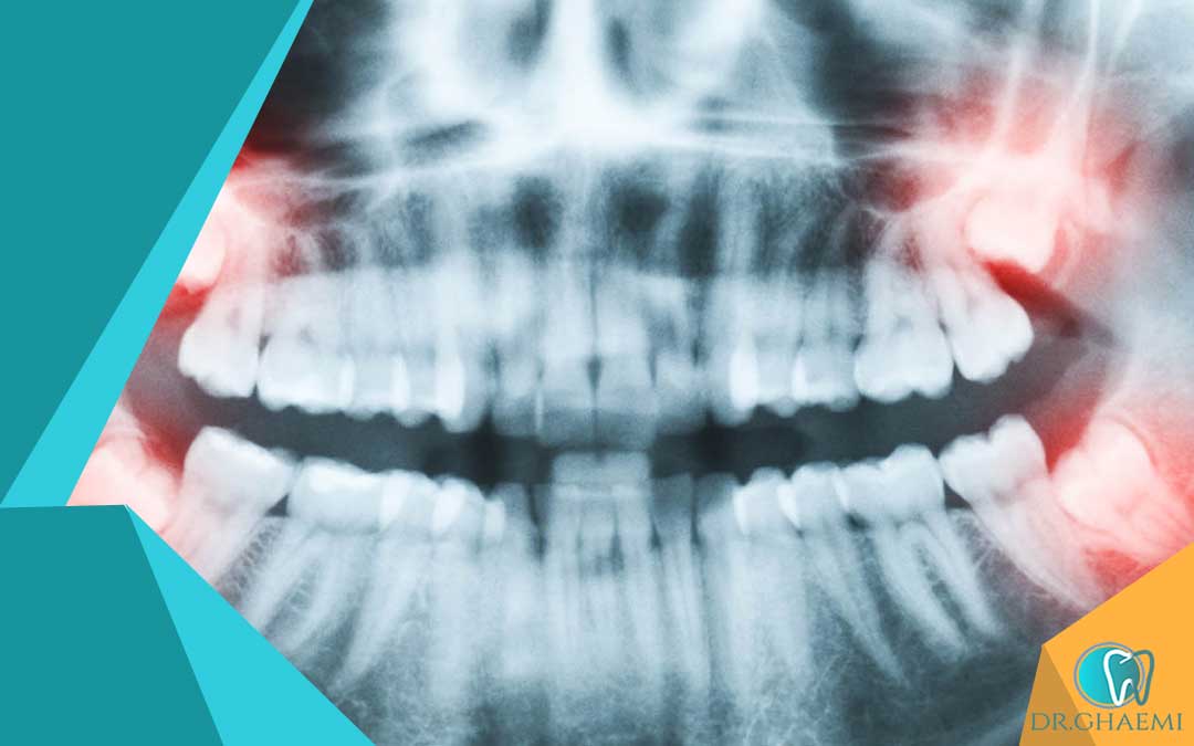 جراحی دندان عقل افقی