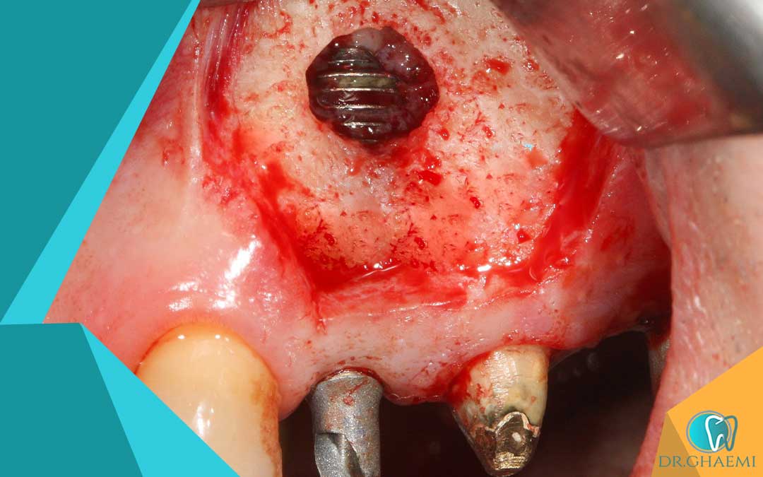فیستول دندان