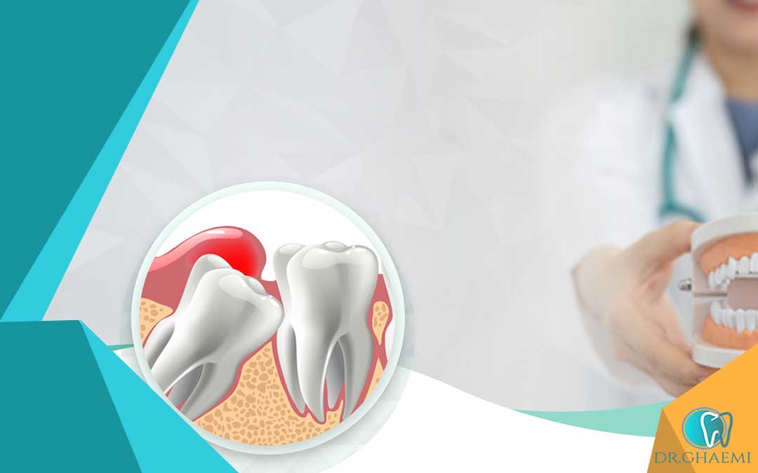 علائمی که نشان می دهد دندان عقل باید کشیده شود: