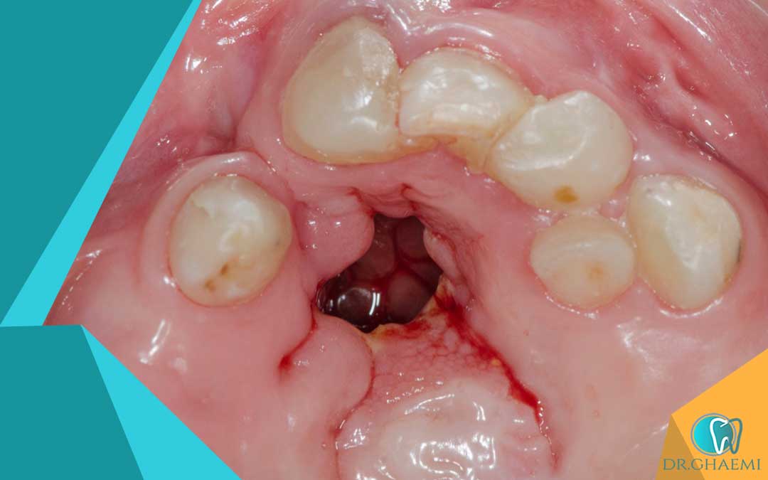 فیستول دندان