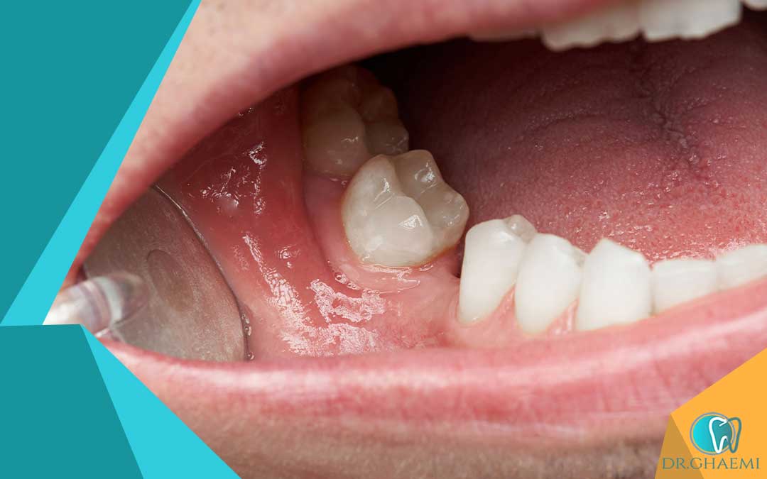 اگر بعد از کشیدن دندان دچار التهاب شدید به پزشک خود اطلاع دهید