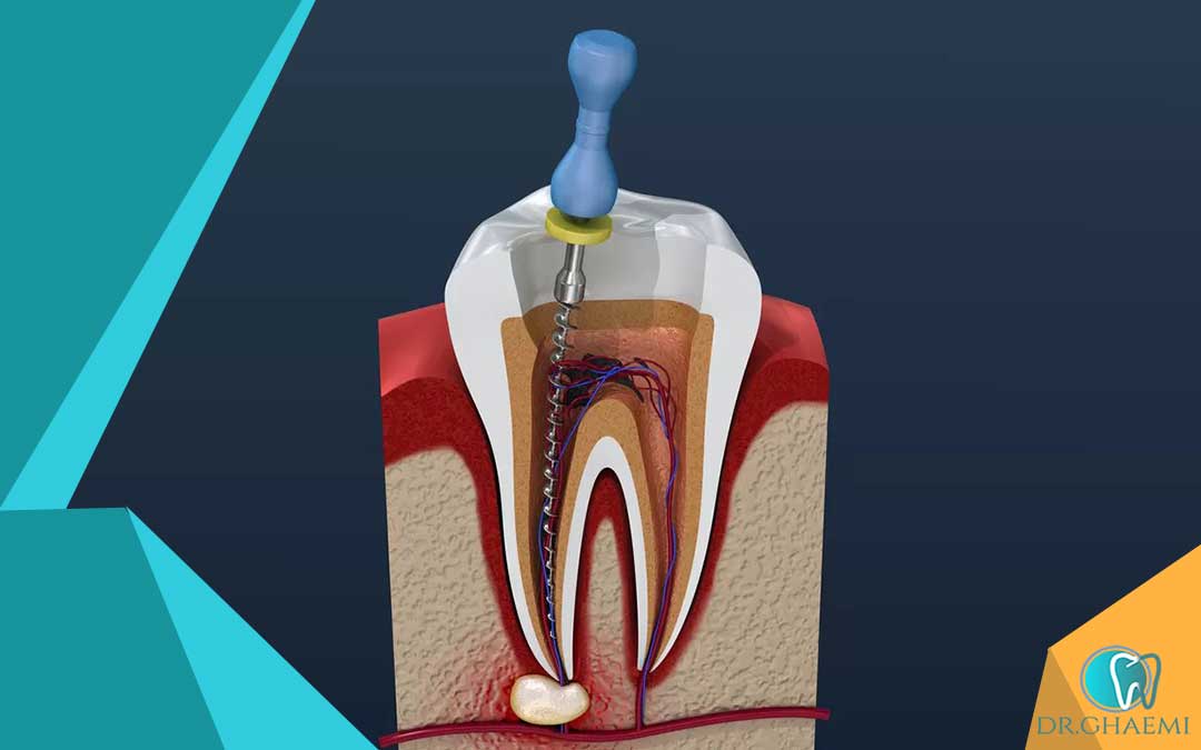 گزینه های درمانی برای عصب کشی ناموفق دندان چیست؟