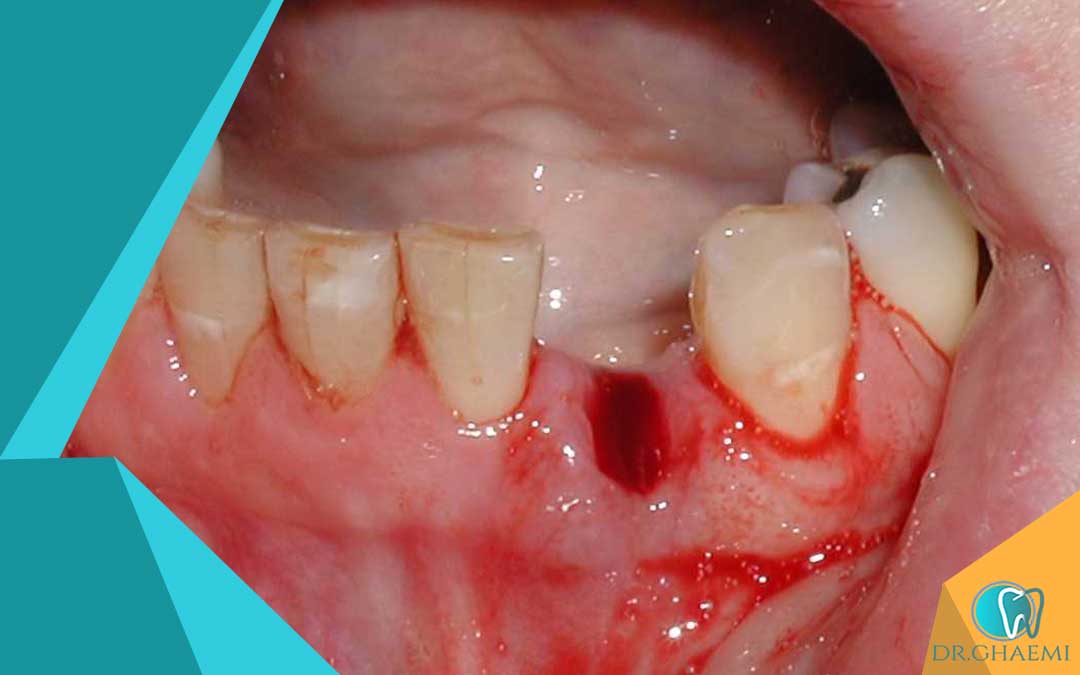 علت عفونت جای دندان کشیده شده چیست؟
