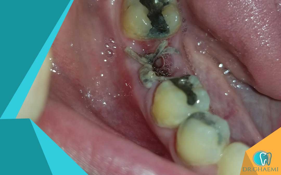 چه اقدامات فردی می‌توانیم در برابر عفونت جای دندان کشیده انجام دهیم؟