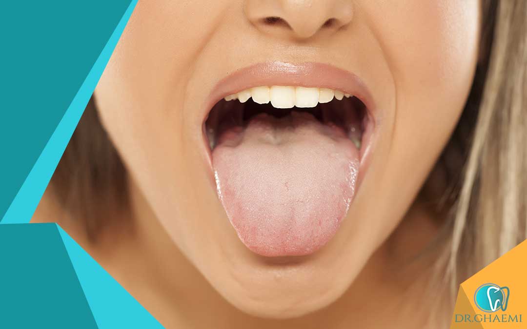 چگونه می توانم از سندرم سوزش دهان جلوگیری کنیم؟