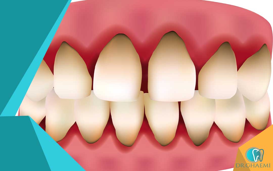 ­چه عواملی باعث سوختگی دندان و لثه میشود: