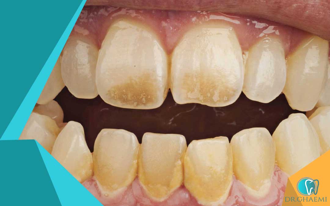 نحوه جلوگیری از سوختگی لثه در اثر سفید کردن دندان