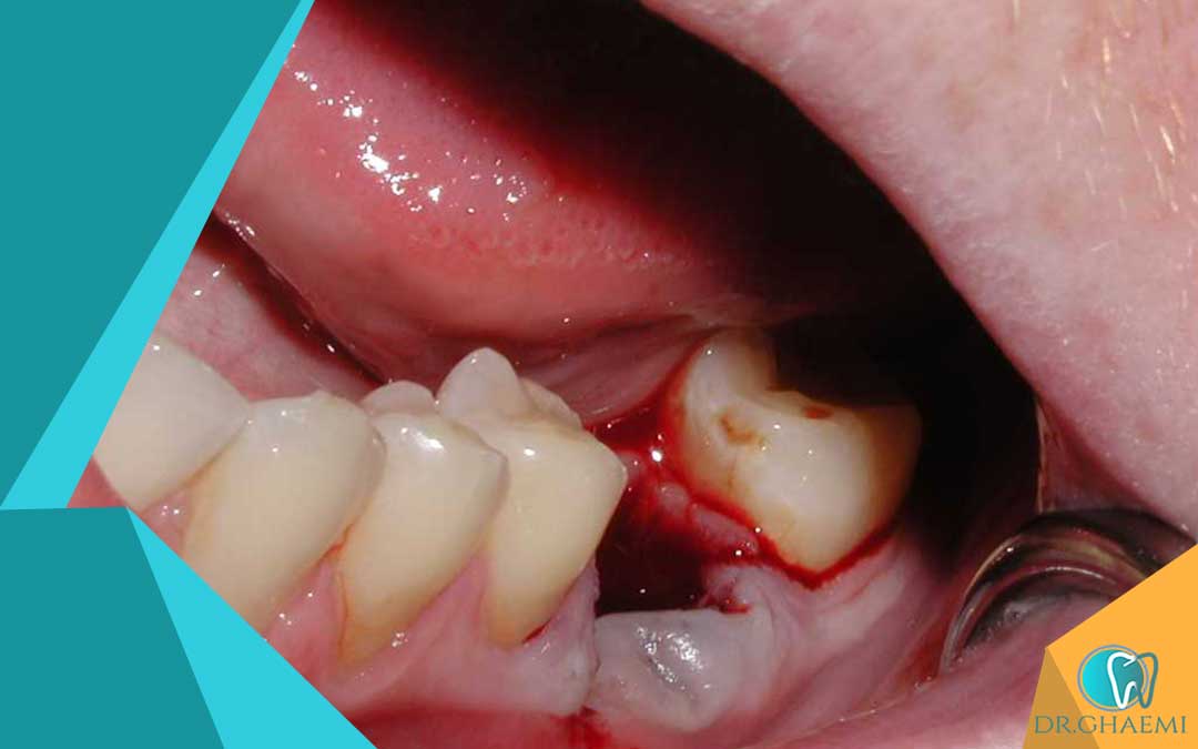 دلایل جراحی دندان پوسیده
