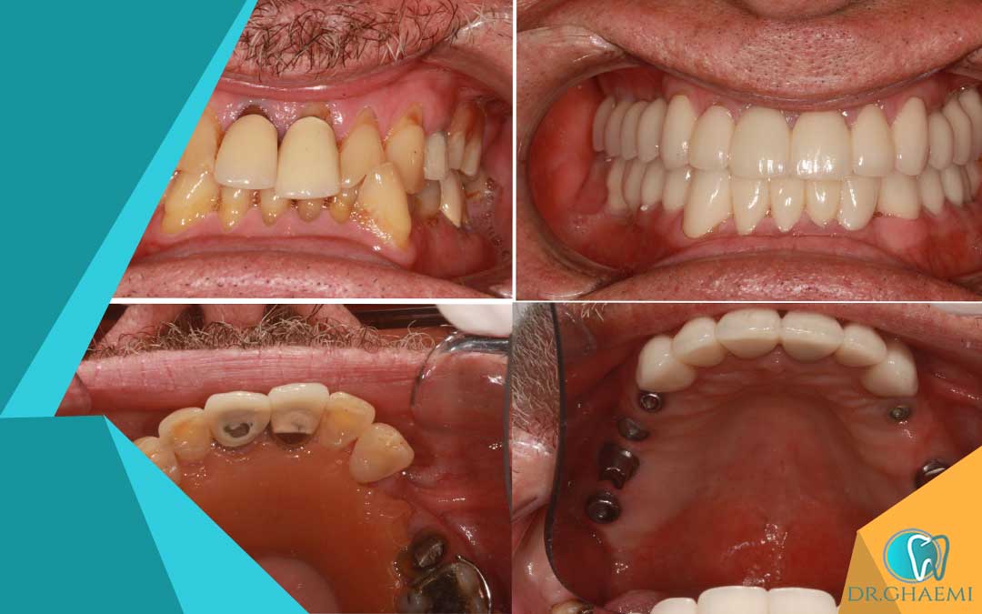 برای اطمینان از درمان با کیفیت، رعایت نکات زیر برای روز جراحی دندان مفید است: