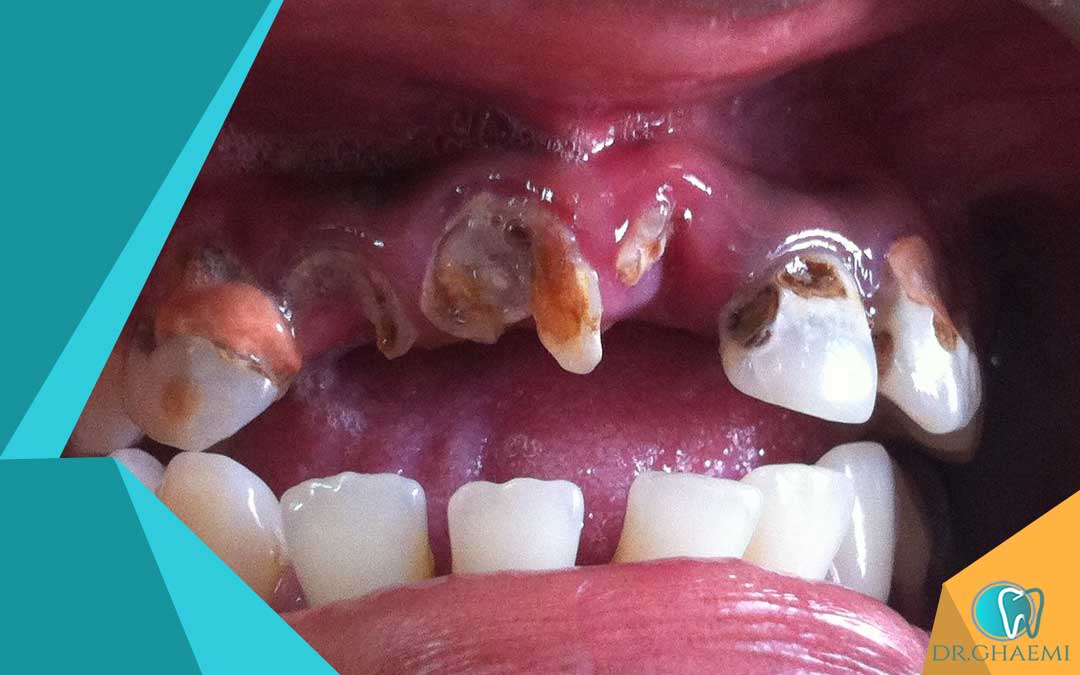 در طول جراحی دندان پوسیده چه انتظاری باید داشت