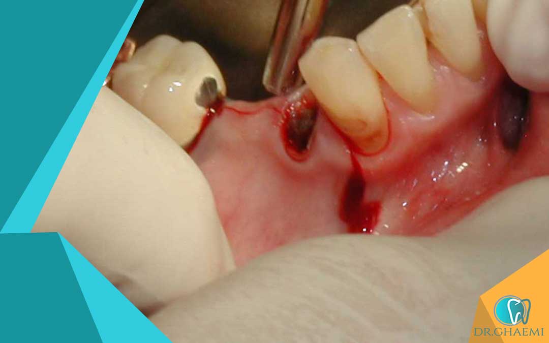 کشیدن دندان پوسیده ساده در مقابل جراحی دندان پوسیده 