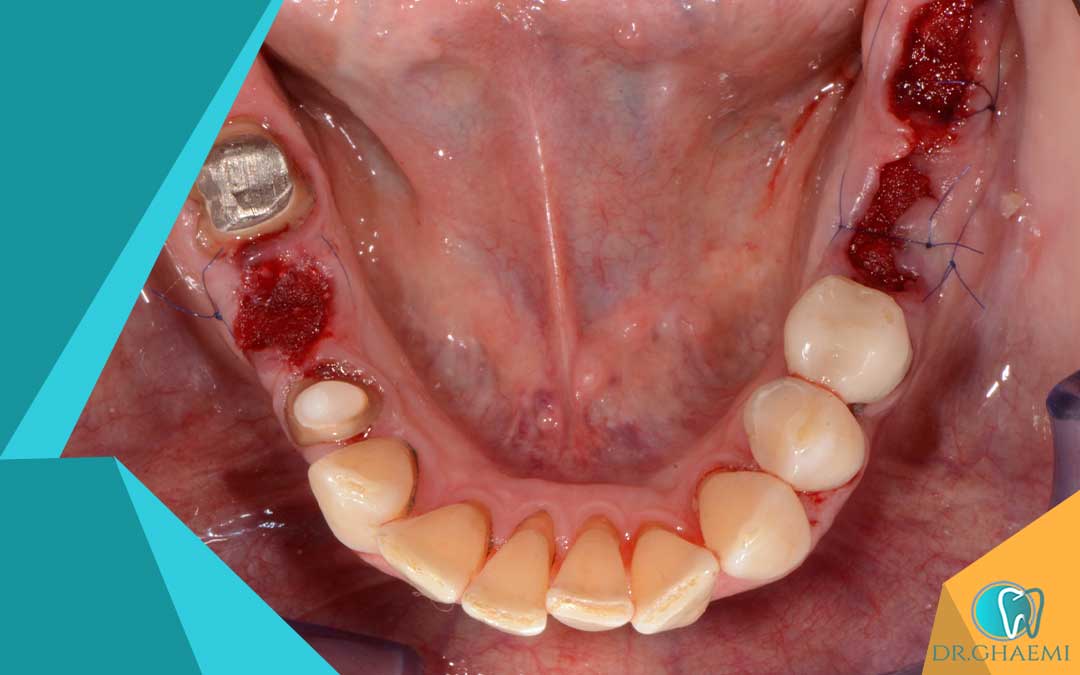 فرایند کشیدن دندان شامل چه مواردی است؟