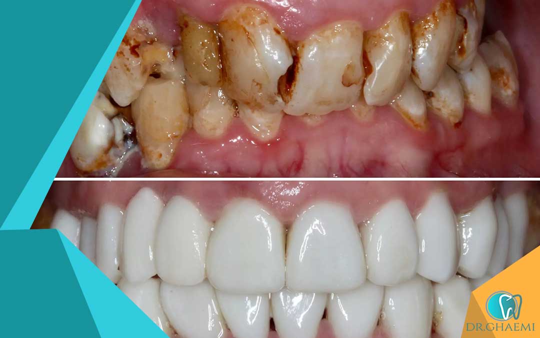 حساسیت دندان بعد از روکش چگونه درمان می‌شود؟