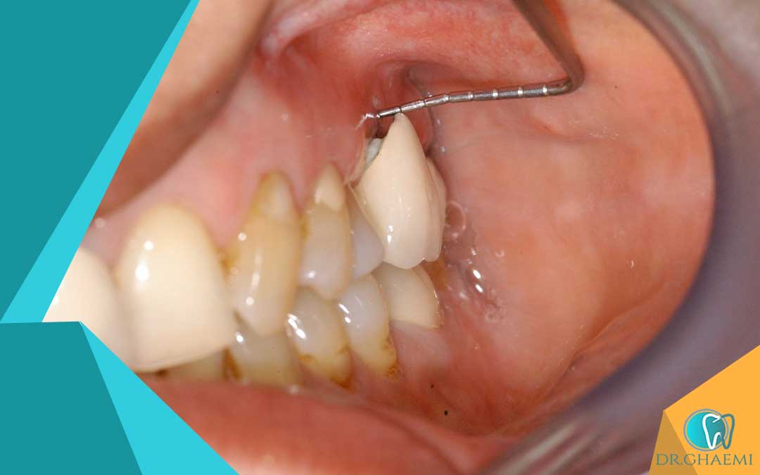 آسیب‌ها و معایب روکش های دندانی پرسلن و زیرکونیوم 