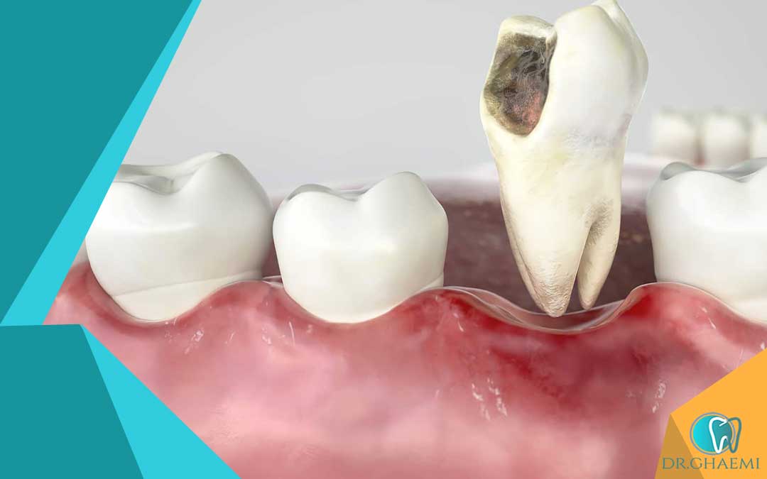 مراحل کشیدن دندان