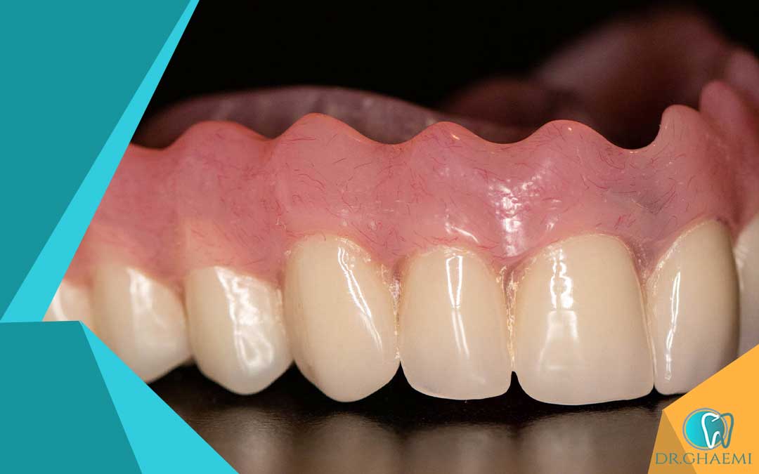 دندان مصنوعی تهرانپارس از چه چیزی ساخته شده است؟