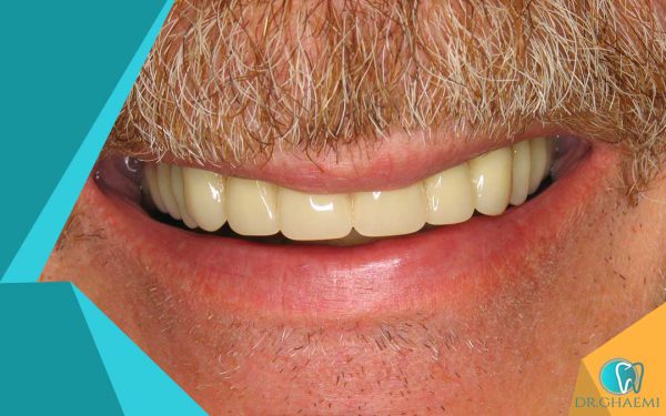 دندان مصنوعی تهرانپارس