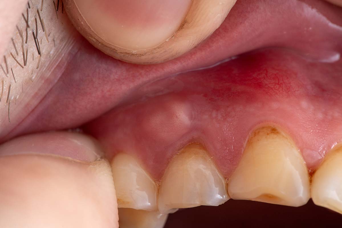 عفونت جای دندان کشیده شده - کلینیک دندانپزشکی قائمی