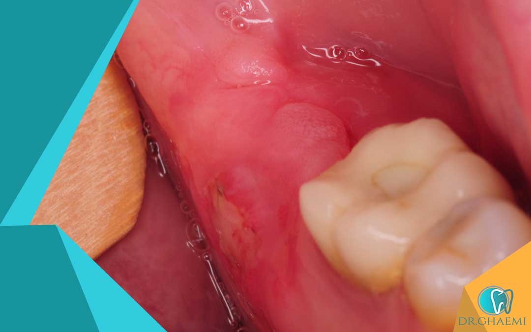 علائم عفونت لثه پس از کشیدن دندان