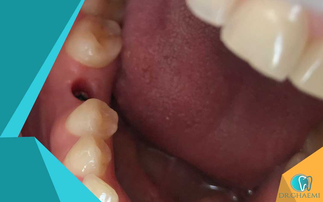 اثرات درمان پوکی استخوان بر سلامت دهان و دندان