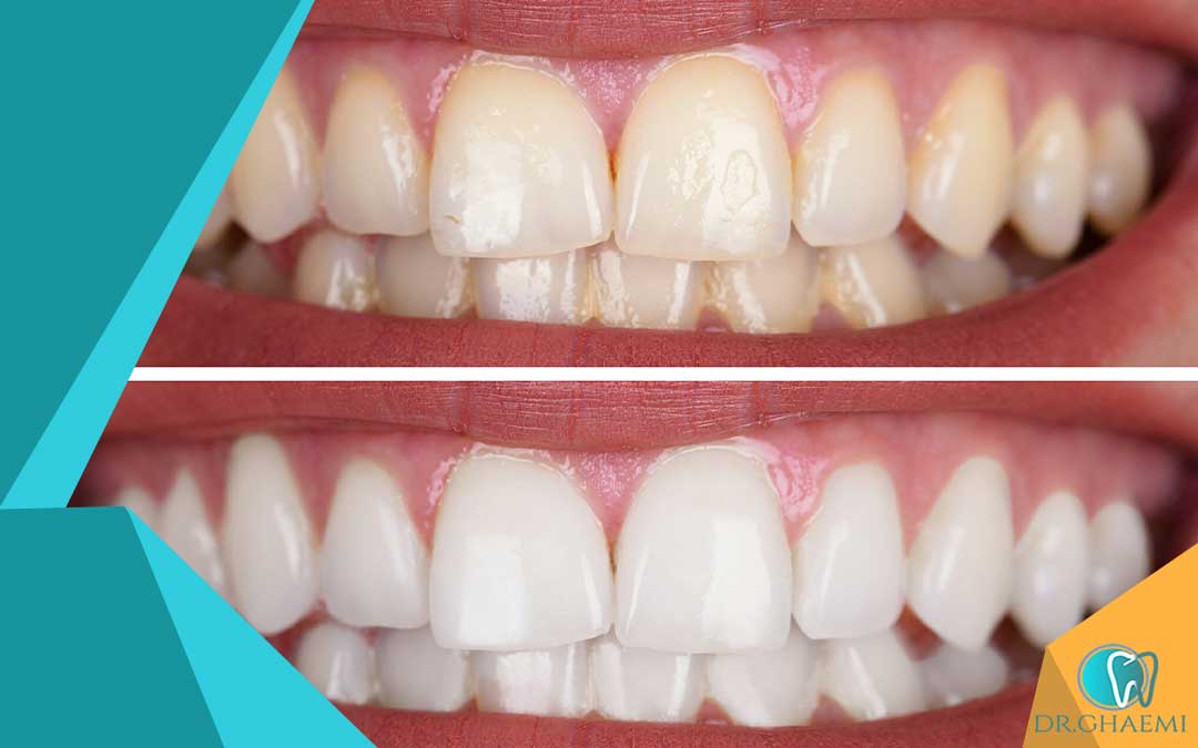 قبل و بعد سفید کردن فوری دندان