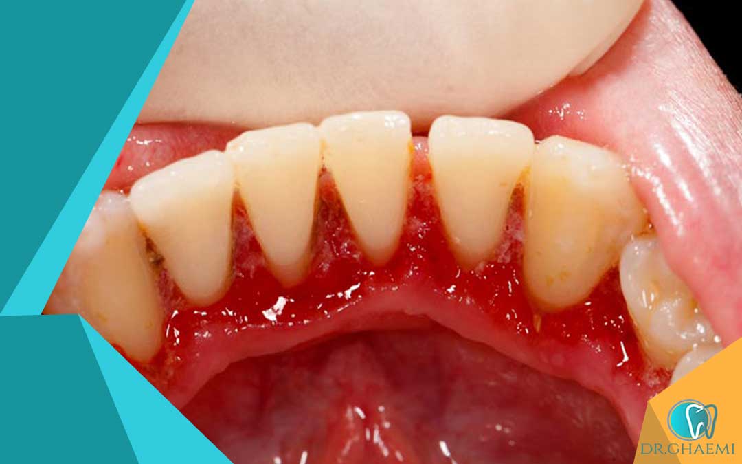 دندانپزشکی عمومی و پوکی استخوان