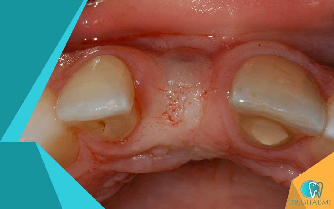 پس از کشیدن دندان، مراقب علائم زیر باشید که می تواند نشان دهنده عفونت لثه بعد از کشیدن دندان باشد.