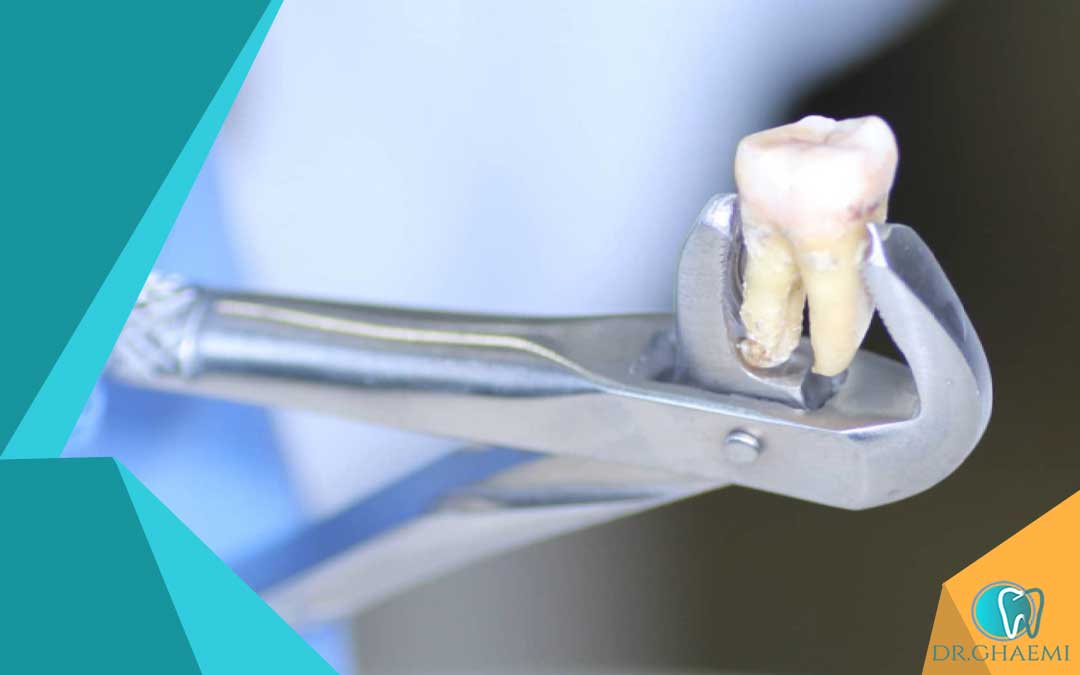 چگونه دندان عقل را بکشیم؟
