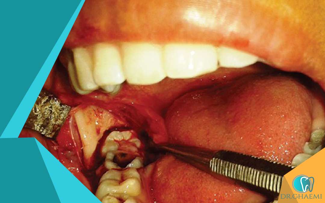آیا دندان عقل حتماً باید کشیده شود؟