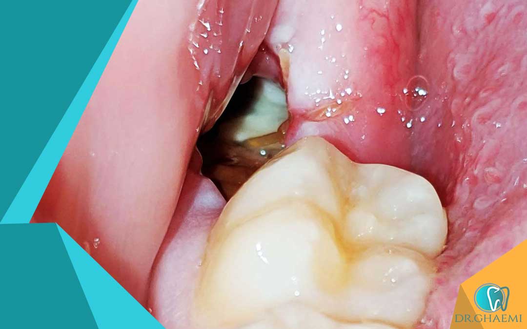 در صورت خونریزی پس از کشیدن دندان عقل چه باید کرد: