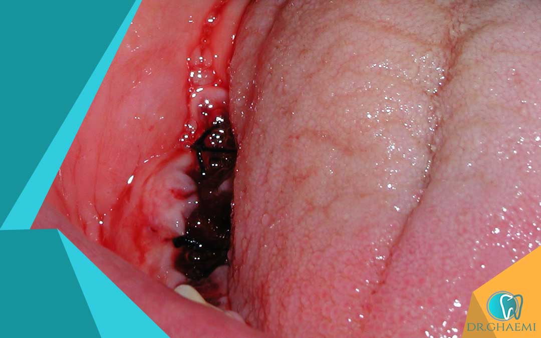   چگونه خونریزی پس از کشیدن دندان عقل را متوقف کنیم؟