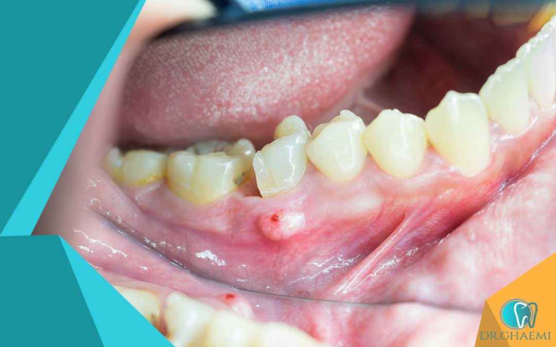 رسیدگی به عفونت های دندانی در جمعیت های خاص
