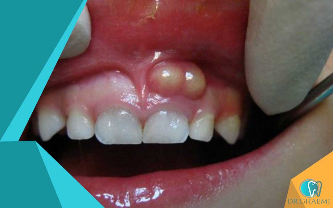 علائم و نشانه های عفونت دندان