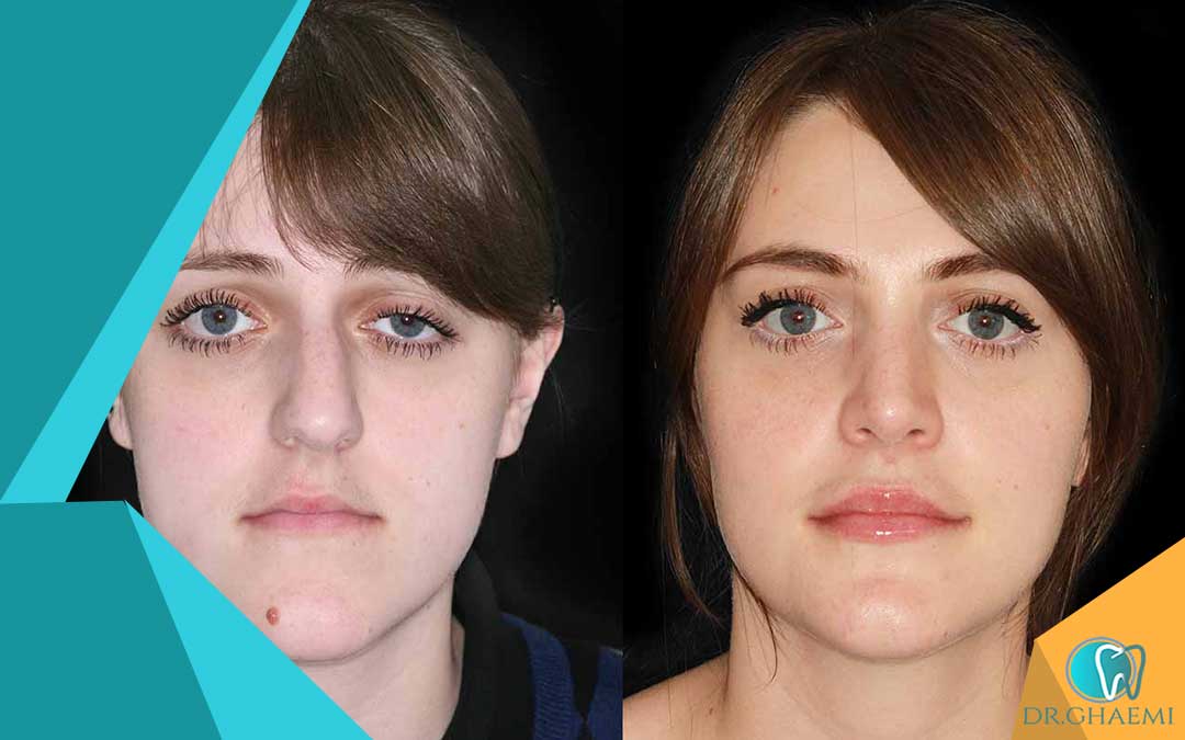 قبل و بعد جراحی ارتوگناتیک