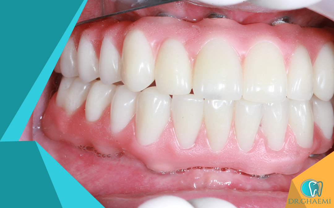  عوامل موثر بر هزینه جراحی دندان