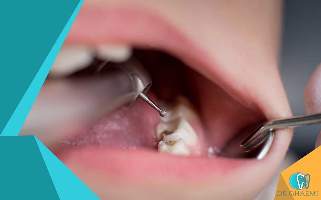 عوارض بالقوه کشیدن دندان عقل بدون جراحی