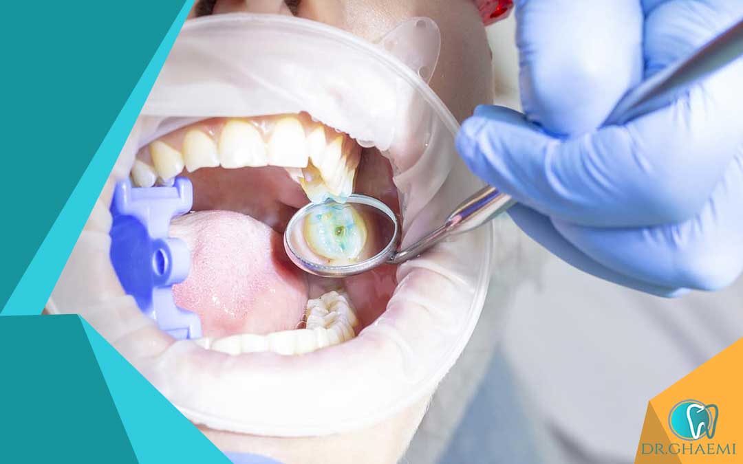 نکاتی برای بهداشت دهان و دندان پس از جراحی تاج دندان