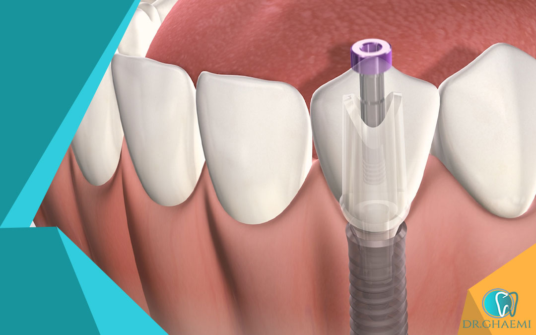  مقایسه جراحی تاج دندان با سایر ترمیم های دندانی